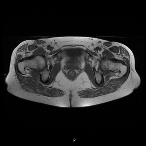 File:Bilateral ovarian fibroma (Radiopaedia 44568-48293 Axial T1 24).jpg
