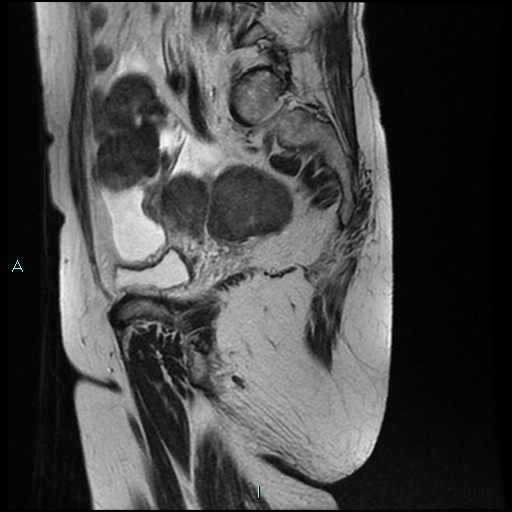 File:Bilateral ovarian fibroma (Radiopaedia 44568-48293 Sagittal T2 24).jpg