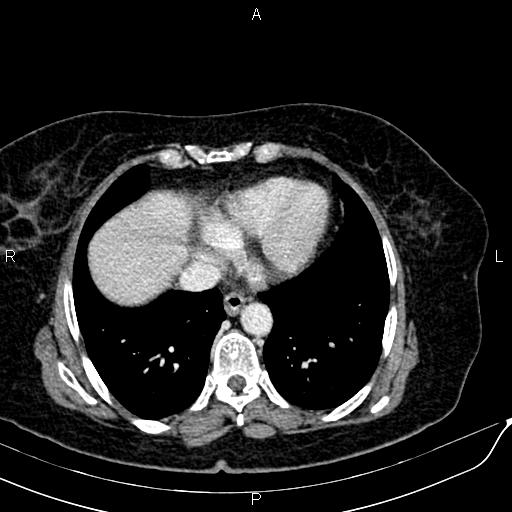 Bilateral ovarian serous cystadenocarcinoma (Radiopaedia 86062-101989 B 11).jpg