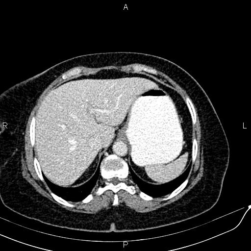 Bilateral ovarian serous cystadenocarcinoma (Radiopaedia 86062-101989 B 20).jpg