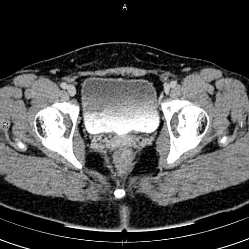 Bilateral ovarian teratoma (Radiopaedia 83131-97503 B 66).jpg