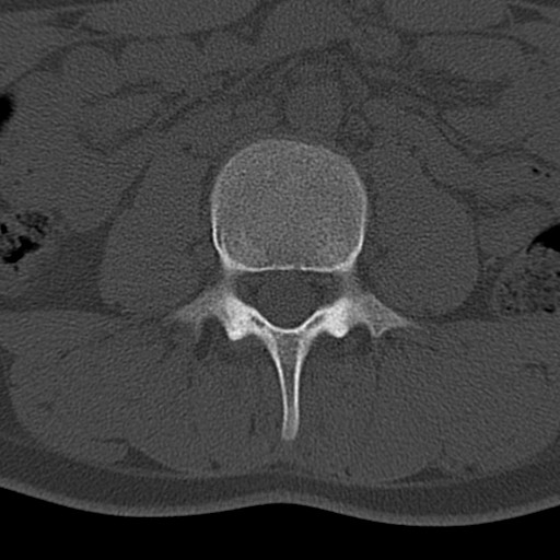 Bilateral pars defect (Radiopaedia 26691-26846 Axial bone window 5).jpg