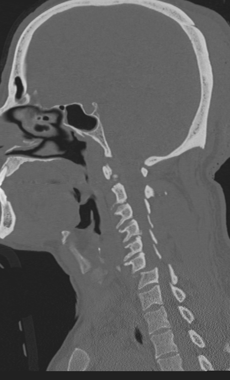 Bilateral perched facet joint (Radiopaedia 63149-71669 Sagittal bone window 19).jpg