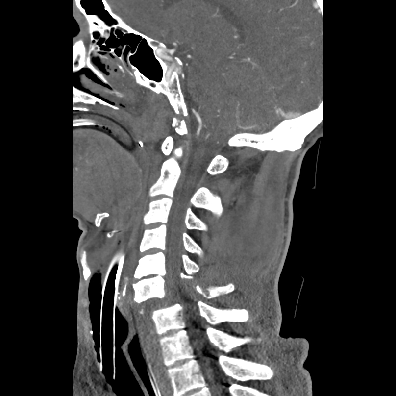 Bilateral perched facets with cord injury (Radiopaedia 45587-49713 B 27).jpg