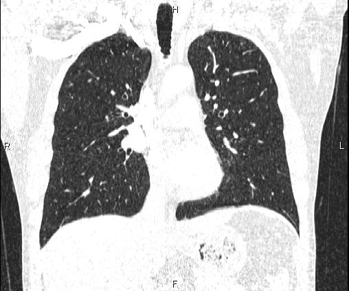 Bilateral pulmonary AVM (Radiopaedia 83134-97505 Coronal lung window 41).jpg