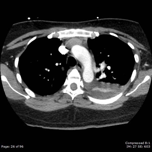 Bilateral pulmonary emboli with Hampton hump sign (Radiopaedia 54070-60246 Axial C+ CTPA 23).jpg