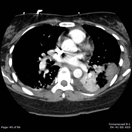File:Bilateral pulmonary emboli with Hampton hump sign (Radiopaedia 54070-60246 Axial C+ CTPA 37).jpg