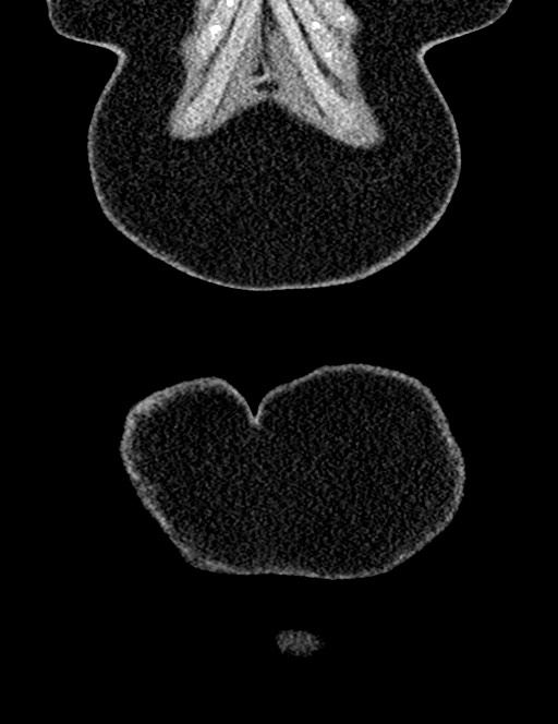 Bilateral staghorn calculi (Radiopaedia 59475-66842 Coronal non-contrast 27).jpg