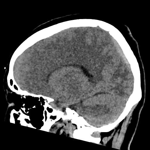 File:Bilateral subacute subdural hematoma (Radiopaedia 69240-79018 C 31).jpg
