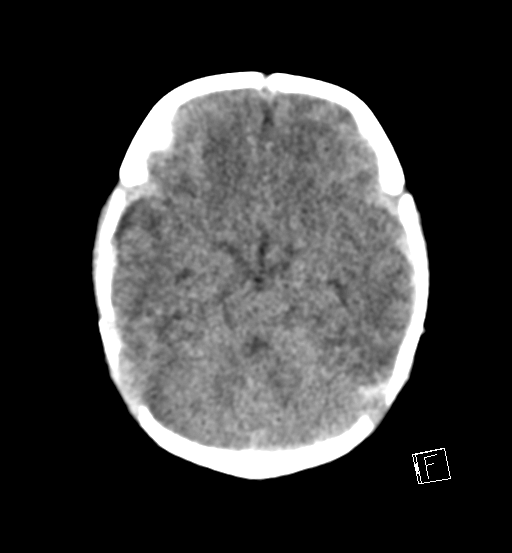 File:Bilateral subdural hemorrhage and parietal skull fracture (Radiopaedia 26058-26192 Axial non-contrast 17).png