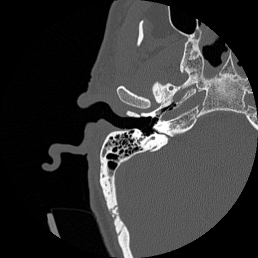 File:Bilateral temporal bone fractures (Radiopaedia 29482-29970 Axial non-contrast 5).jpg