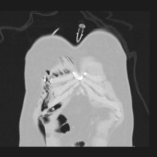 File:Bilateral traumatic renovascular injury (Radiopaedia 32051-32995 Coronal lung window 6).jpg
