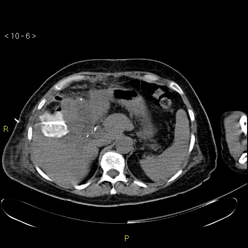 File:Biloma with drainage into the colon (Radiopaedia 20032-20068 B 6).jpg