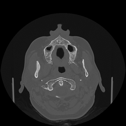 File:Bisphosphonate-related osteonecrosis of the jaw (Radiopaedia 71324-81642 Axial bone window 115).jpg