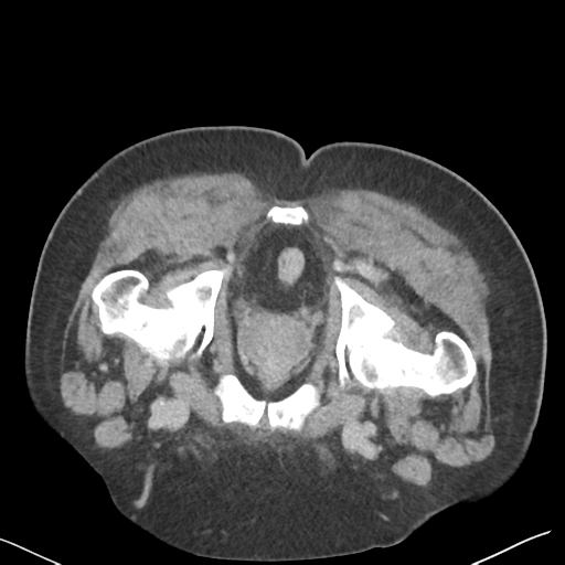 File:Bladder papillary urothelial carcinoma (Radiopaedia 48119-52951 Axial C+ delayed 59).png