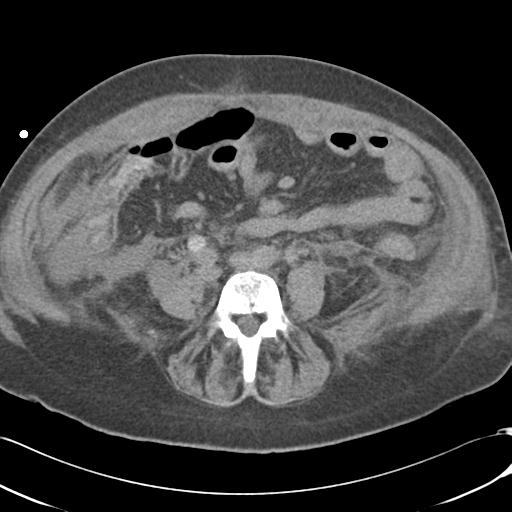 File:Bladder rupture post renal biopsy (Radiopaedia 30863-31572 Axial non-contrast 54).jpg