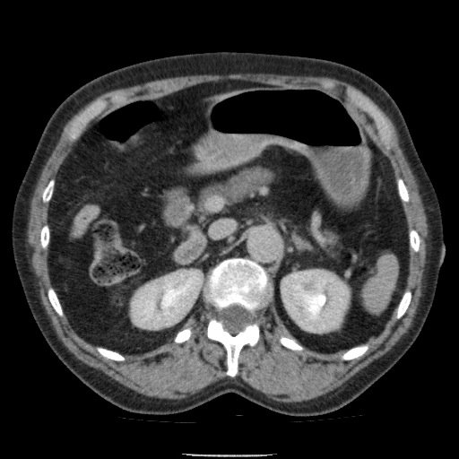 Bladder tumor detected on trauma CT (Radiopaedia 51809-57609 C 44).jpg