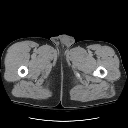 File:Blunt abdominal trauma with solid organ and musculoskelatal injury with active extravasation (Radiopaedia 68364-77895 Axial C+ delayed 158).jpg