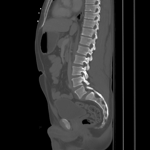 Blunt abdominal trauma with solid organ and musculoskelatal injury with active extravasation (Radiopaedia 68364-77895 Sagittal bone window 48).jpg