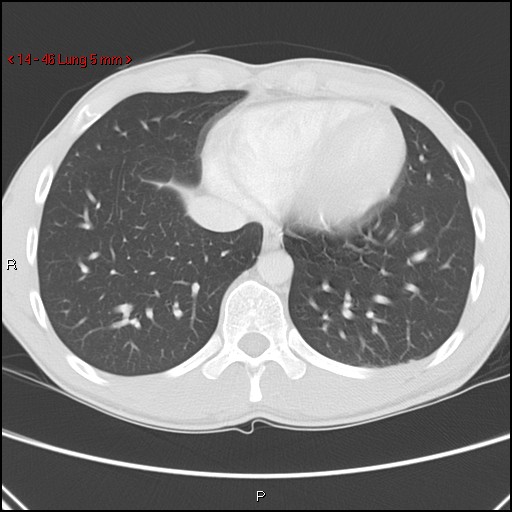 File:Blunt chest trauma - pulmonary interstitial emphysema and pneumomediastinum (Radiopaedia 20666-20552 Axial lung window 46).jpg