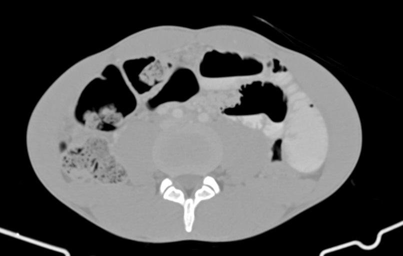 Blunt injury to the small bowel (Radiopaedia 74953-85987 Axial Wide 55).jpg