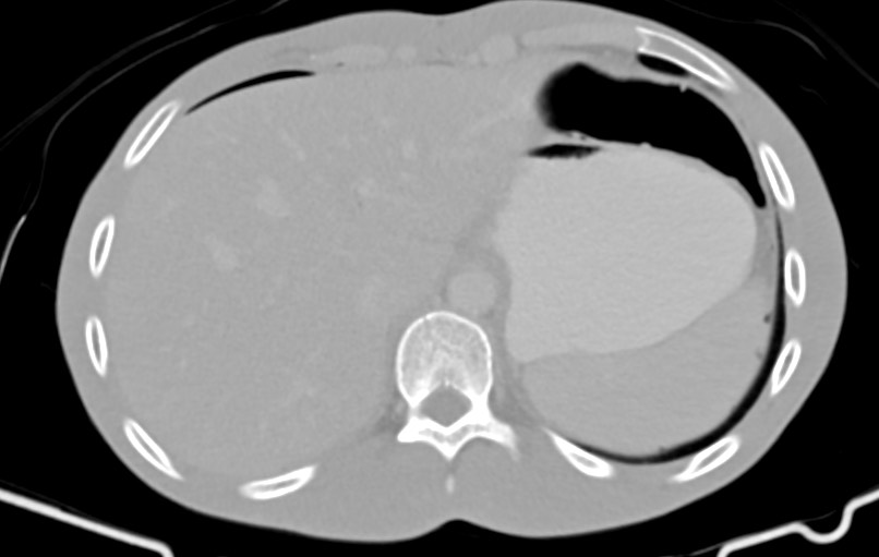 Blunt injury to the small bowel (Radiopaedia 74953-85987 Axial Wide 8).jpg
