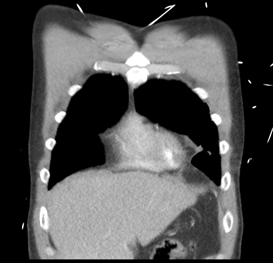 File:Boerhaave syndrome (Radiopaedia 39382-41661 B 13).png