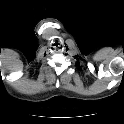 Boerhaave syndrome (Radiopaedia 59796-67310 Axial liver window 3).jpg