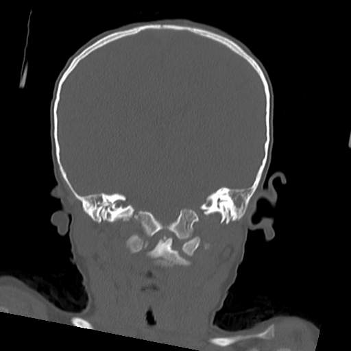 File:Bony atresia of the right external auditory canal (Radiopaedia 27916-28156 Coronal bone window 9).jpg