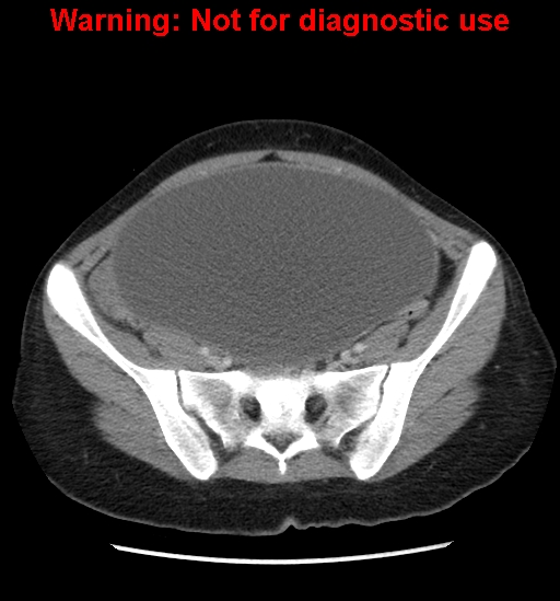 Borderline mucinous cystadenoma of ovary (Radiopaedia 25586-25767 A 76).jpg