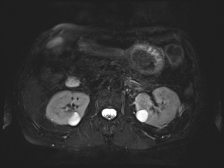 File:Bouveret syndrome (Radiopaedia 61017-68856 Axial MRCP 29).jpg