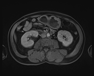 File:Bouveret syndrome (Radiopaedia 61017-68856 Axial T1 C+ fat sat 51).jpg