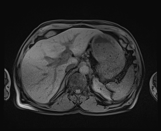 Bouveret syndrome (Radiopaedia 61017-68856 Axial T1 fat sat 21).jpg