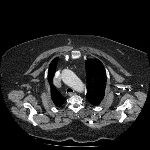 Bovine aortic arch - right internal mammary vein drains into the superior vena cava (Radiopaedia 63296-71875 A 31).jpg