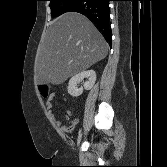 File:Bowel and splenic infarcts in acute lymphocytic leukemia (Radiopaedia 61055-68913 C 52).jpg