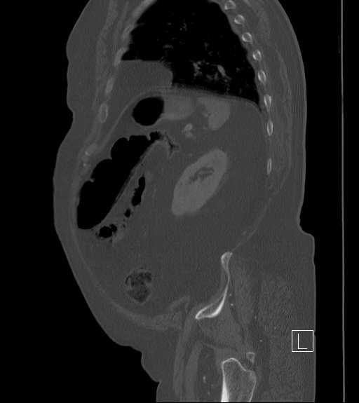 Bowel ischemia secondary to SMA occlusion with extensive portomesenteric venous gas (Radiopaedia 54656-60871 Sagittal bone window 23).jpg