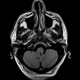 File:Brain abscess complicated by intraventricular rupture and ventriculitis (Radiopaedia 82434-96571 Axial FLAIR 3).jpg