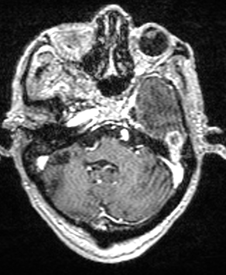 Brain abscess with dual rim sign (Radiopaedia 87566-103938 Axial T1 C+ 44).jpg