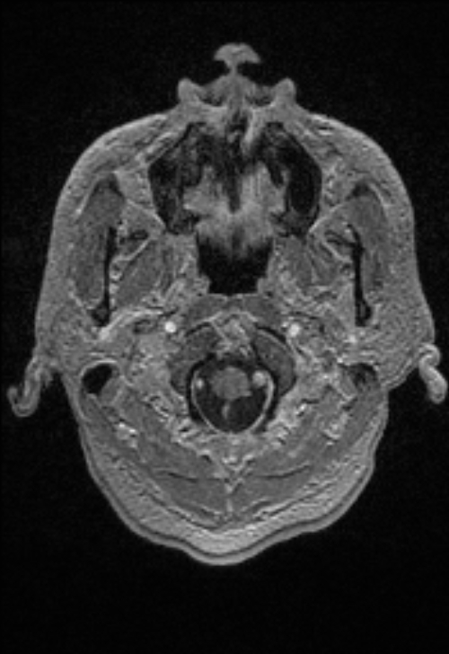 Brain abscess with ventriculitis (Radiopaedia 85703-101495 Axial T1 C+ 17).jpg