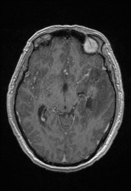 Brain abscess with ventriculitis (Radiopaedia 85703-101495 Axial T1 C+ 81).jpg