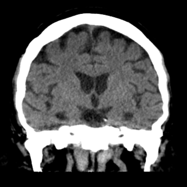 Brain cortical laminar necrosis (Radiopaedia 25822-25971 C 26).jpg
