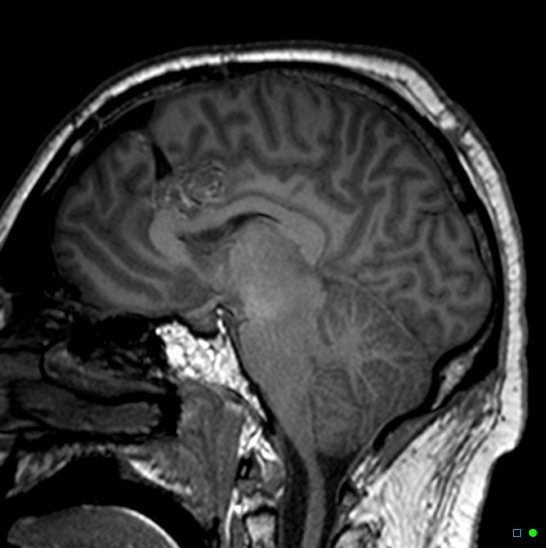 Brain death on MRI and CT angiography (Radiopaedia 42560-45689 Sagittal T1 30).jpg