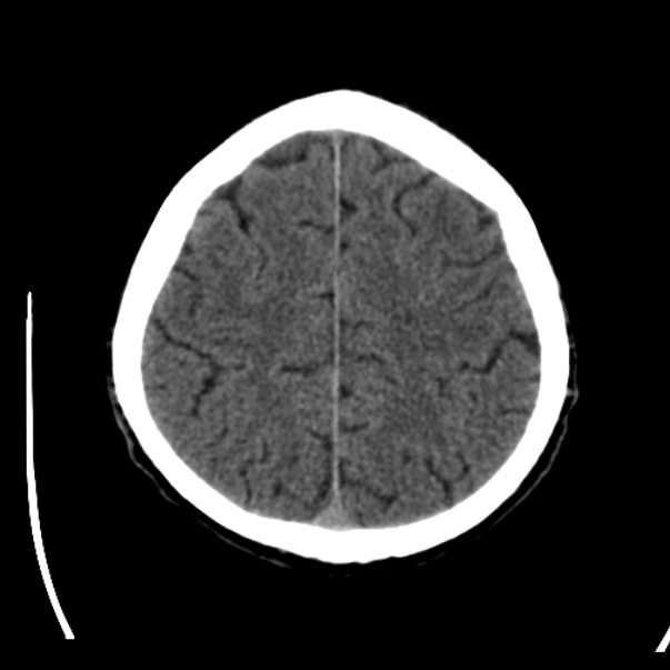 Brain metastases from lung cancer (Radiopaedia 24480-24781 Axial non-contrast 39).jpg