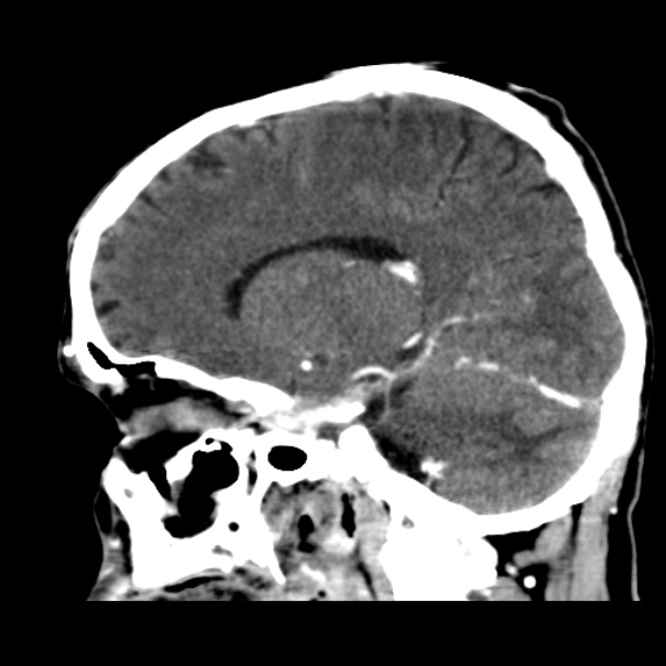 Brain metastases from lung cancer (Radiopaedia 24480-24781 C+ delayed 24).jpg