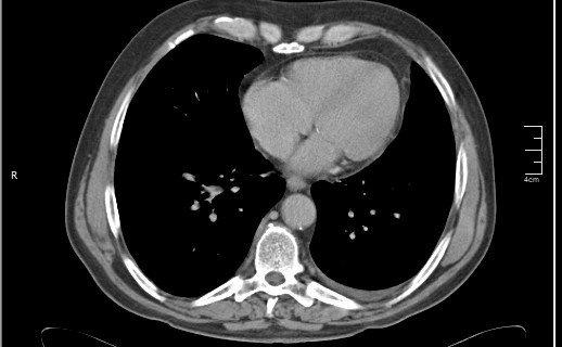 File:Brain metastases from squamocellular lung cancer (Radiopaedia 56515-63219 B 44).jpg