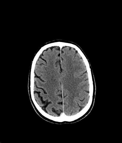 Brain metastasis (large cystic mass) (Radiopaedia 47497-52106 Axial C+ 44).png