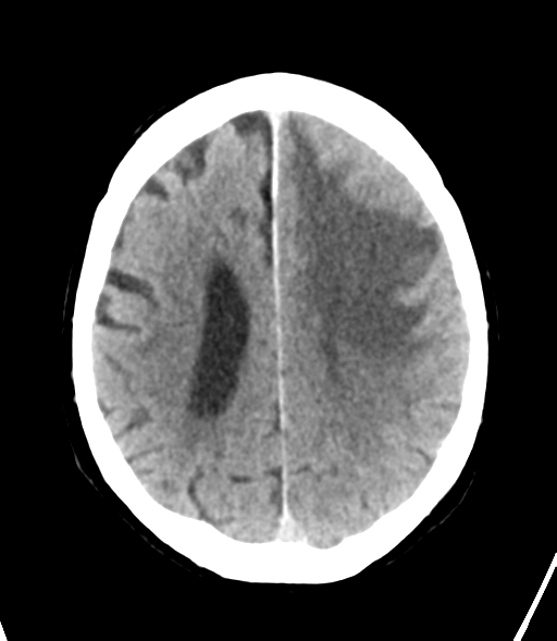 File:Brain metastasis (lung cancer) (Radiopaedia 48289-53177 Axial non-contrast 23).png