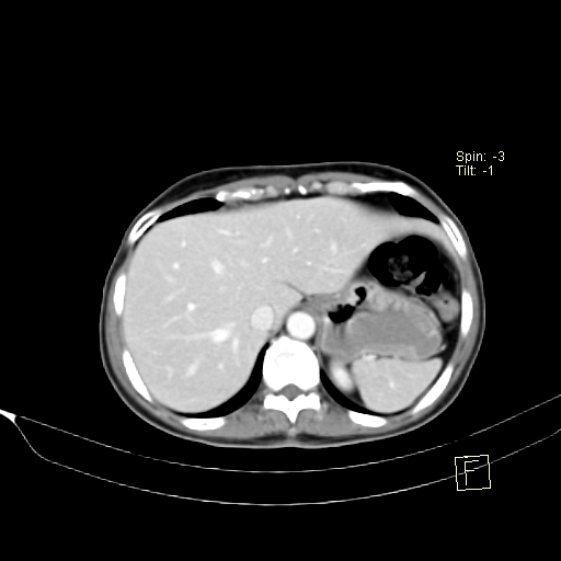 File:Brain metastasis as initial presentation of non-small cell lung cancer (Radiopaedia 65122-74127 A 43).jpg