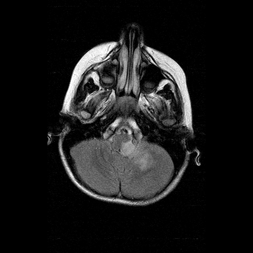 File:Brainstem ganglioglioma (Radiopaedia 10763-11224 Axial FLAIR 16).jpg