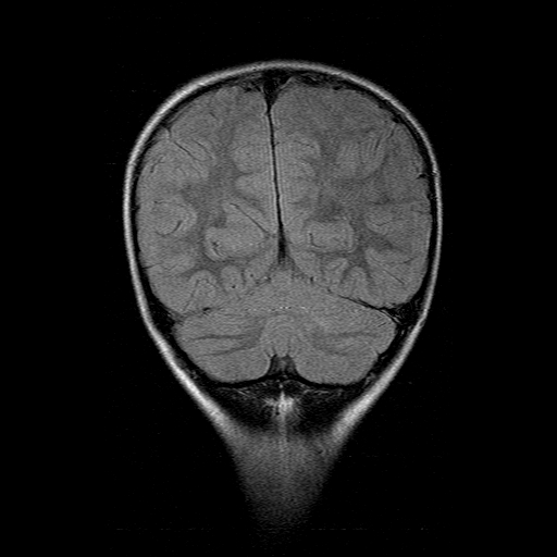 File:Brainstem ganglioglioma (Radiopaedia 10763-11224 Coronal FLAIR 5).jpg